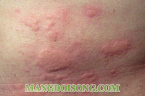 NHẬN BIẾT BỆNH QUA CÁC DẤU HIỆU TRÊN DA BẠN 1