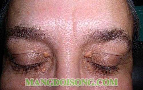 NHẬN BIẾT BỆNH QUA CÁC DẤU HIỆU TRÊN DA BẠN 4