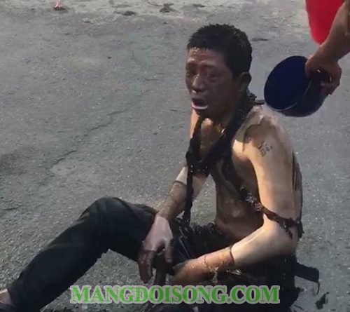 Cách chữa bỏng sơ cứu bỏng đúng cách khoa học nhất giúp nạn nhân thoát cơn nguy kịch 1