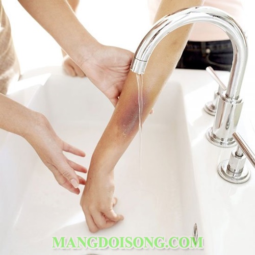 Cách chữa bỏng sơ cứu bỏng đúng cách khoa học nhất giúp nạn nhân thoát cơn nguy kịch3