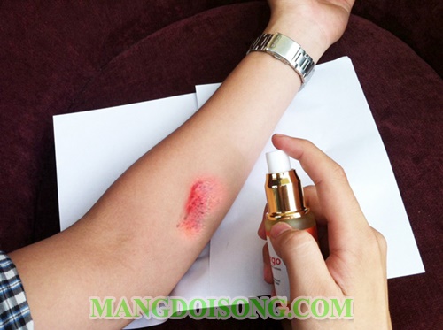 Cách chữa bỏng sơ cứu bỏng đúng cách khoa học nhất giúp nạn nhân thoát cơn nguy kịch 4