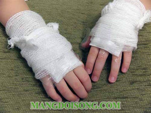 Cách chữa bỏng sơ cứu bỏng đúng cách khoa học nhất giúp nạn nhân thoát cơn nguy kịch 6